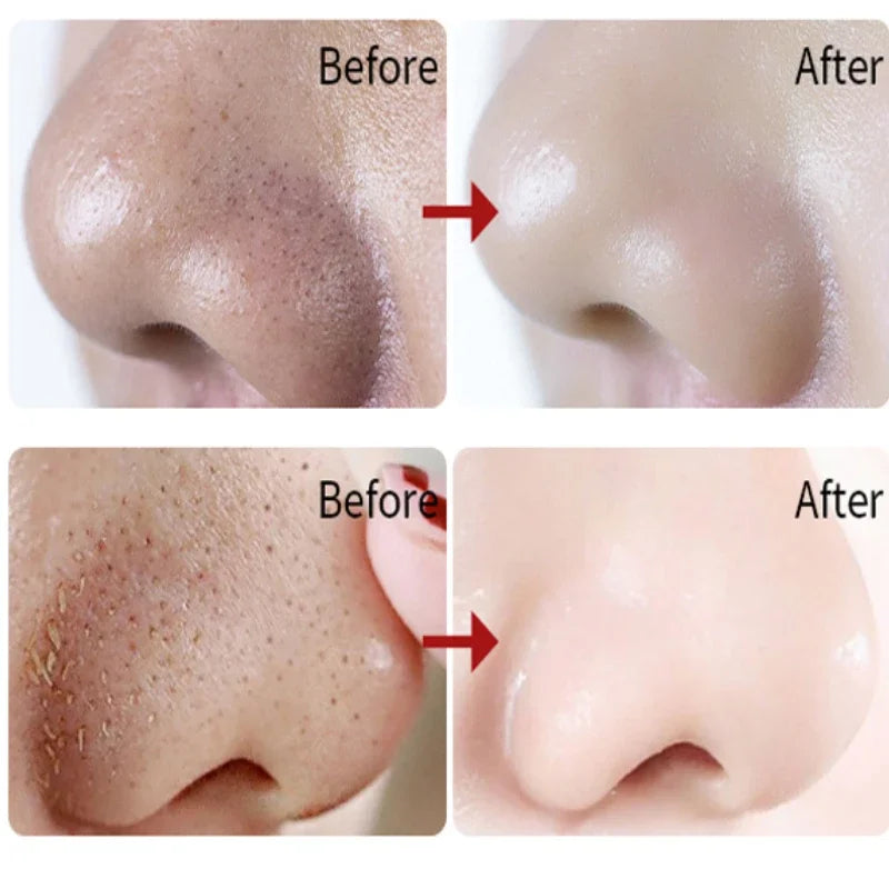 Nose Blackhead Remover Mask Deep Cleansing Shrink Pore Acne Treatment Mask