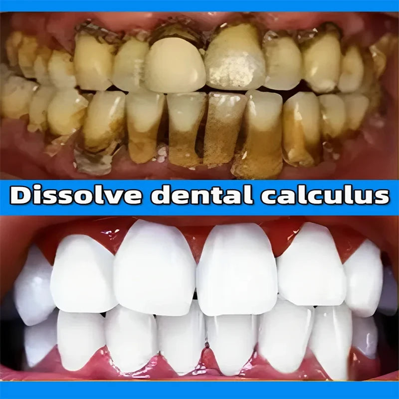 Dental Calculus Remover Whitening Removal Bad Breath Teeth Toothpaste